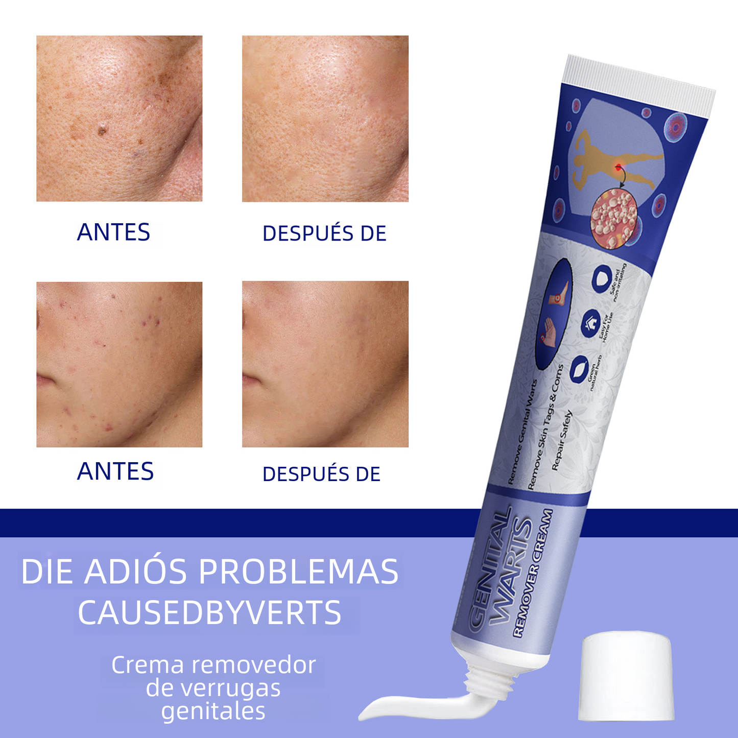 South Moon Wart Removal Cream for Skin Repair