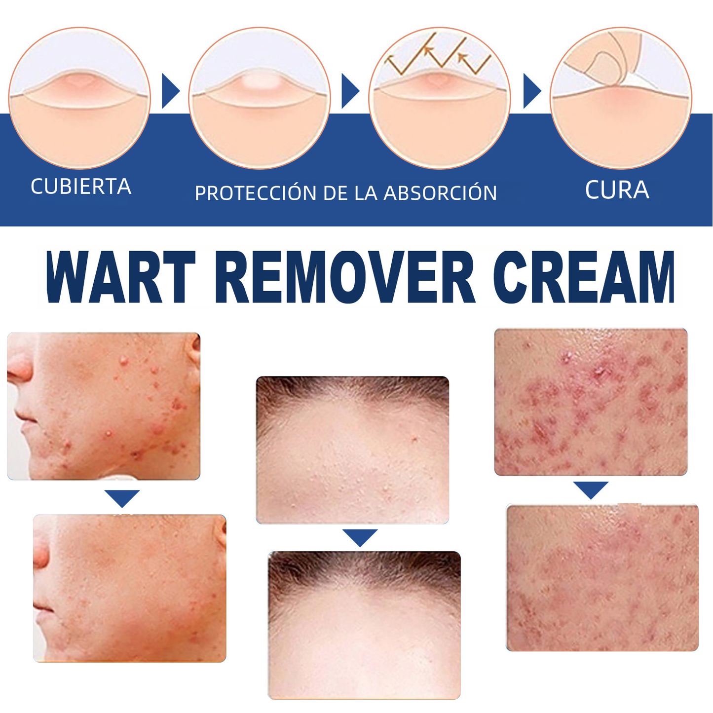 South Moon Wart Removal Cream for Skin Repair
